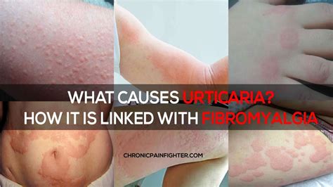 What Causes Urticaria How It Is Linked With Fibromyalgia Urticaria Fibromyalgia