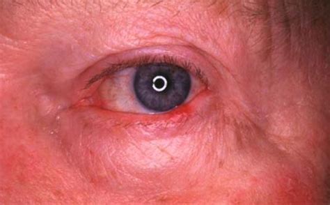 Swollen Eyelid Causes Pictures Allergies Stye Eyelid Gland No