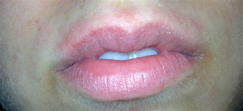 Patch Of Dry Skin Above Lipdownload Free Software Programs Online