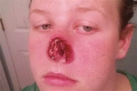 Brave Student Shares Selfies After ‘pimple Turned Out To Be Deadly