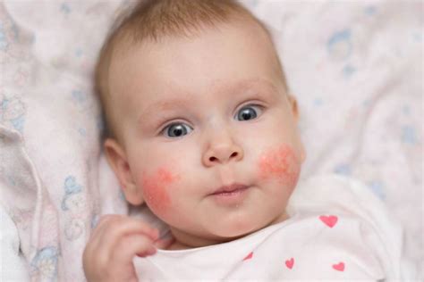 What Is Impetigo Its Causes Diagnosis Treatments And More