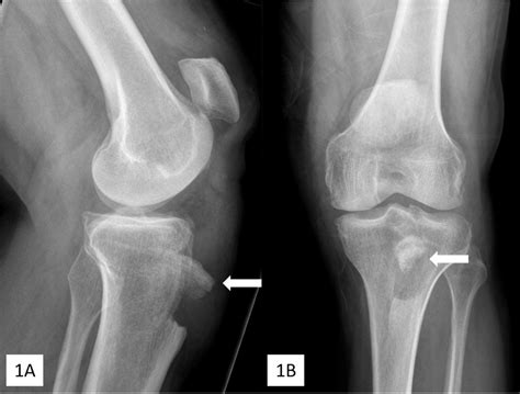 Cureus Combined Tibial Tubercle Fracture With Patellar Tendon The Best Porn Website