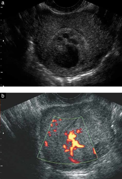 Placental Site Trophoblastic Tumor Diagnosed On Transvaginal Sonography