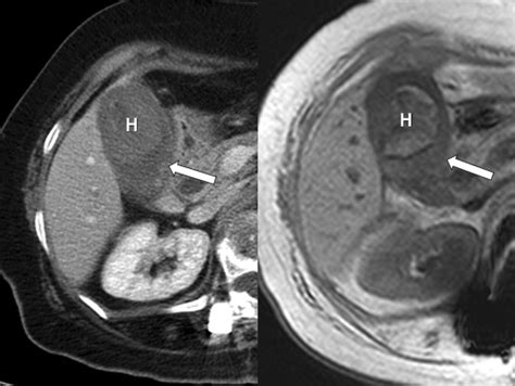 Gallbladder Carcinoma Causes Of Misdiagnosis At Ct Clinical Radiology