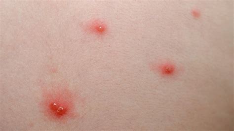 Can Skin Rash Cause Swollen Lymph Nodes