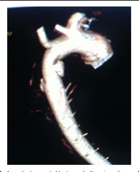 Figure 1 From Thoracic Endovascular Aortic Repair For Traumatic