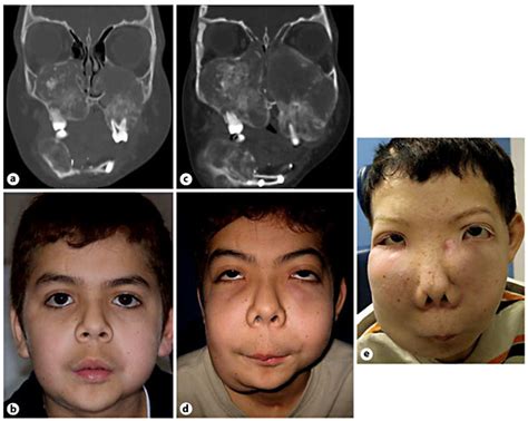 Clinical Findings In Our Patient With Juvenile Ossifying Fibroma A