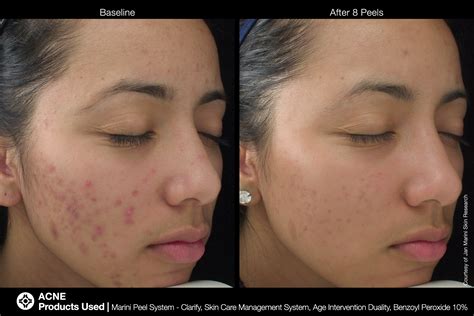 Acne scars, depending on their type, usually need a combination of treatments to improve including chemical peels, microneedling, subcision, laser resurfacing answer: Chemical Peels in Westerville, OH | Westerville Dermatology