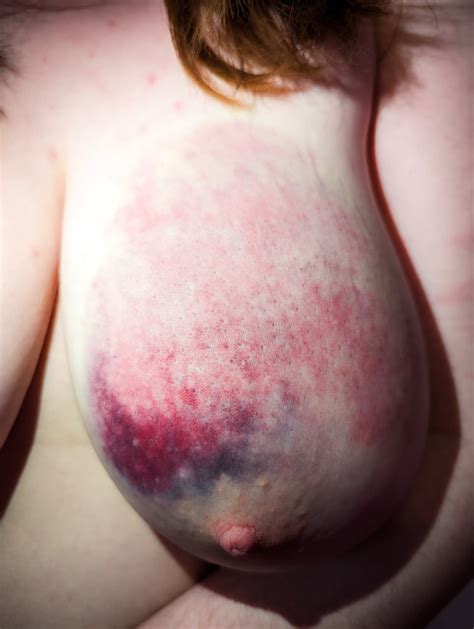my bruised tits after a rough bdsm session 5 pics xhamster