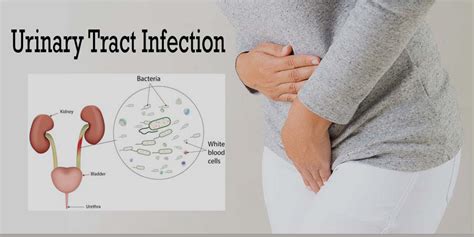 Urinary Tract Infection Treatment Online Consultation Get Online Treatment Gcmd