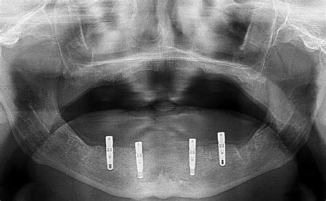 Dental Implants For Dentures X Ray