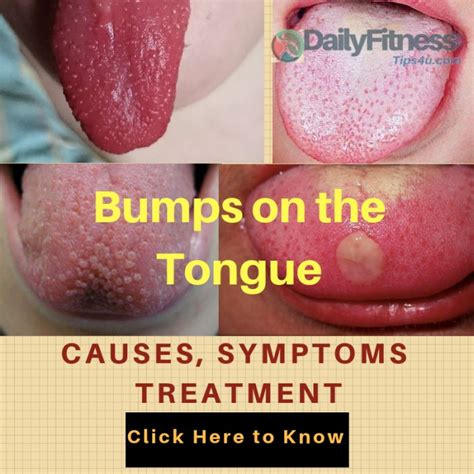 Bumps On The Tongue Causes Picture Symptoms And Treatment