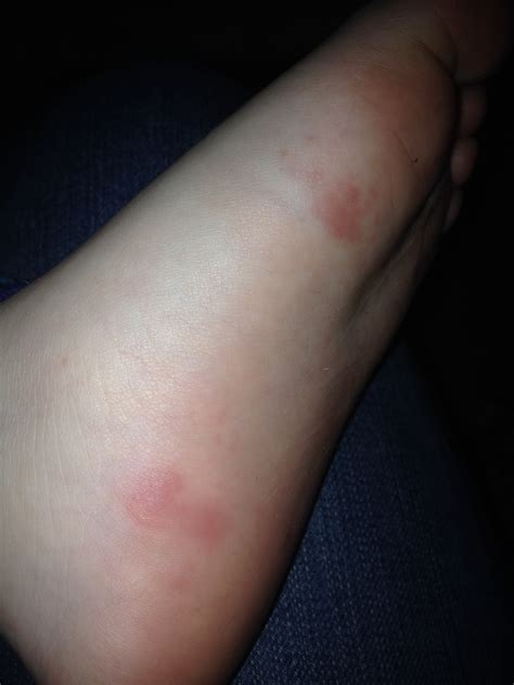 Red Spots On Bottom Of Foot The Bump