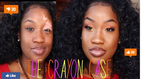 From Beautiful To Baddie Vitiligo Edition Ft The Crayon Case Youtube