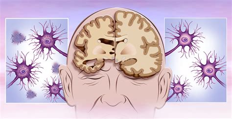 What Happens To The Brain Cells In Dementia Dementia Talk Club