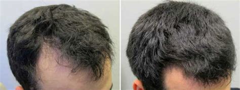 Because taking beta sitosterol exclusively as a hair loss or hair regrowth supplement is a field of study in its early stages, there are no set hard and fast rules. Beta Sitosterol Hair Loss, Dosage, with Saw Palmetto ...