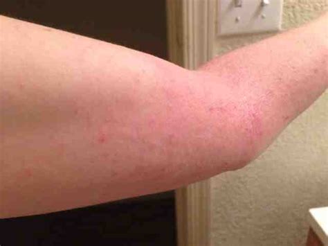 Can Wearing Leggings Cause Itching Skin On Arms