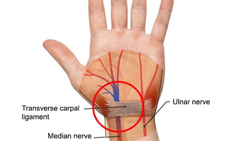 Carpal Tunnel Syndrome Causes Symptoms And Diagnosis Health Plus
