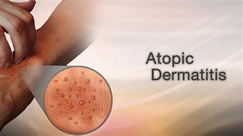 Atopic Dermatitis Treatment Symptoms Causes And More