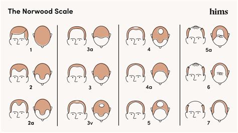 The Norwood Scale Hair Loss Stages And Treatments Hims