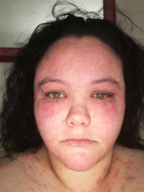 Mum Who Was Left Swollen Scabbed And Scarred By Hair Dye Urges People To Do Patch Tests Metro