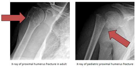 Types Of Proximal Humerus Fractures