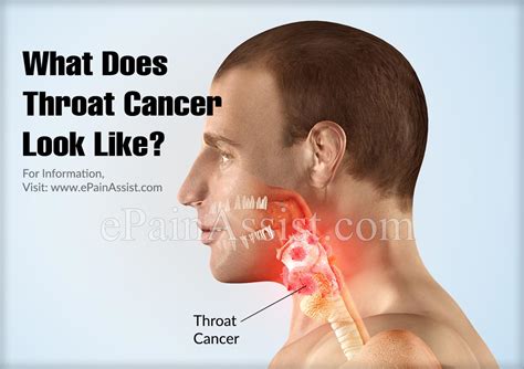 All neck lumps in children and adults should be checked right away by a health care provider. What Does Throat Cancer Look Like?|Survival Rates of ...