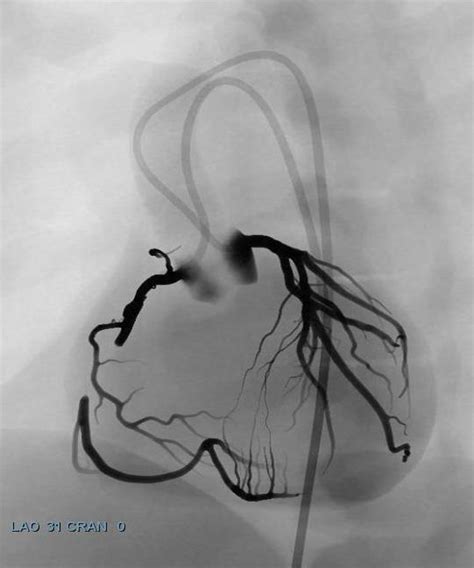 Angio Coronary Cto Module Simbionix