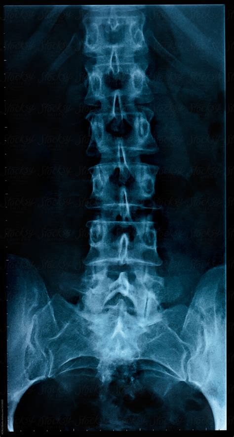 X Ray Of A Spine Of An Human By Stocksy Contributor Acalu Studio