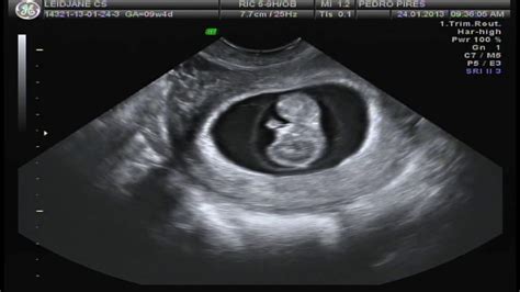 First Pregnancy Ultrasound Gender Confirmed With 9 Weeks Youtube