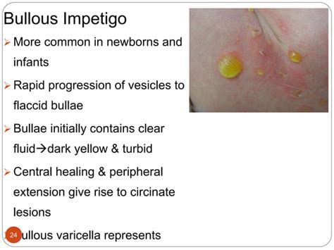 Staphylococcal And Streptococcal Skin Infections Ppt