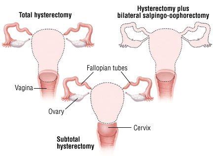 Hysterectomy Before And After