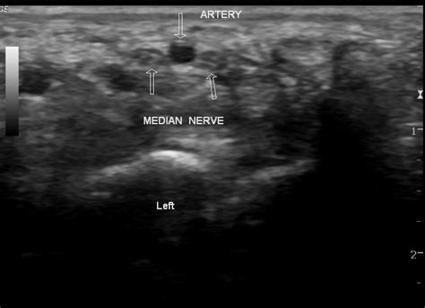 Bilateral Persistent Median Artery Of The Forearm With Unilateral Bifid