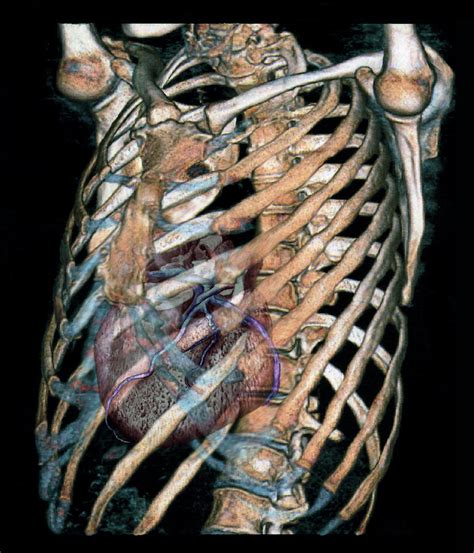 Heart And Rib Cage Photograph By Zephyrscience Photo Library