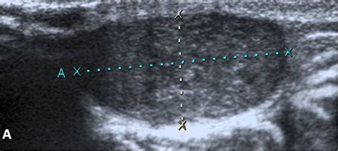 Ultrasound In Solid Breast Masses Benign Versus Malign Selcuk