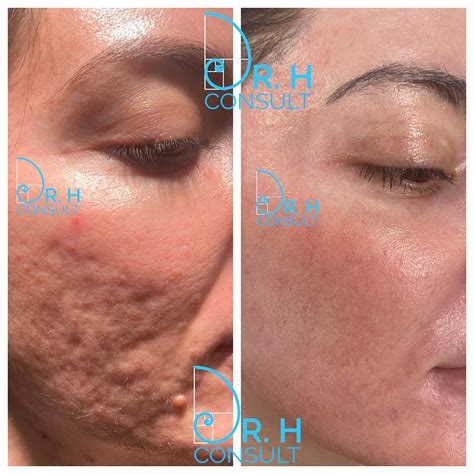 Acne Scar Laser Treatment And Removal London Dr H Consult