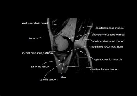 This section of the website will explain large and minute details of sagittal knee. mri knee anatomy | knee sagittal anatomy | free cross ...