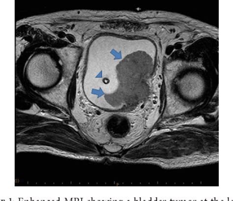 Figure 1 From Surgical Treatment Of Adrenal Gland Metastasis