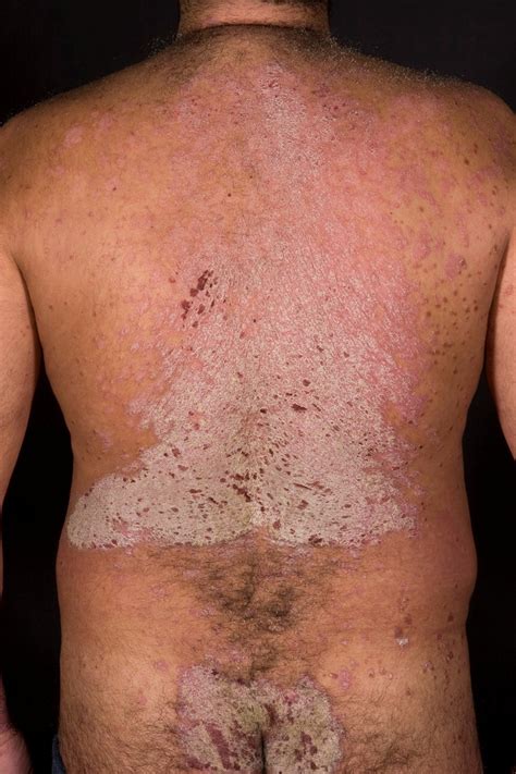 A 41 Year Old Man With An Itchy Rash The Bmj