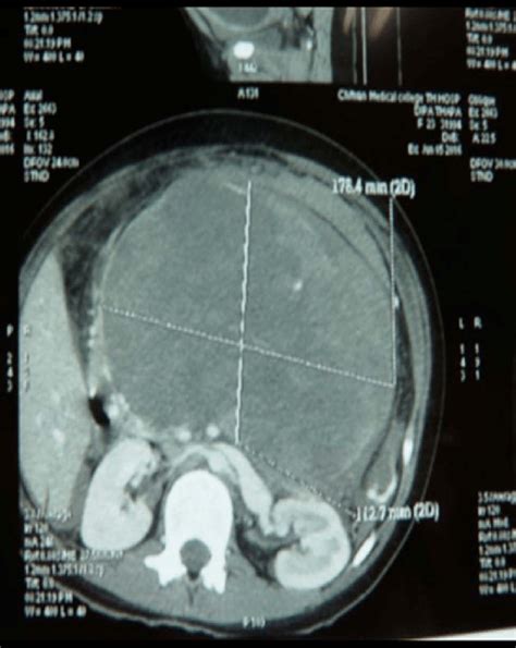 Ct Axial Image Shows Well Defined Heterogeneously Enhancing Mass