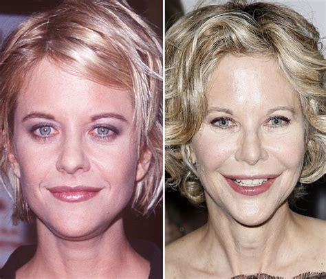 Meg Ryan Plastic Surgery Before And After Photos Lip Vrogue Co