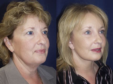 Forehead Cosmetic Surgery Facial Rejuventation