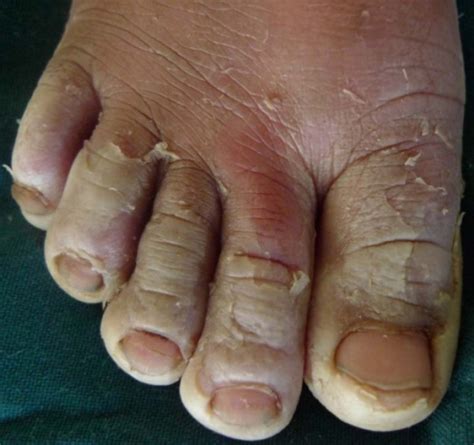 Right Foot Of 6 Years Old Girl With Peeling Of The Feet Open I