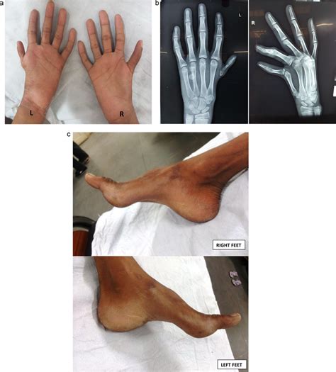 A Showing Hypoplastic Thenar Eminences And Hypoplastic Thumb Of Both