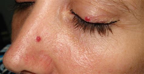 Cherry Angioma On Scalp Treatment Hemangiomas Skin Conditions We