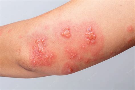 What Is Shingles What Are The Symptoms And How To Treat Them