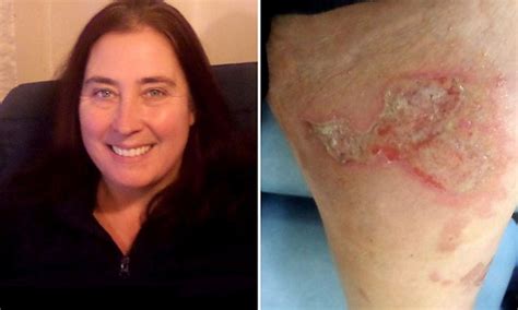mother left with horrific leg burns after spilling boiling cup of mcdonald s tea daily mail online