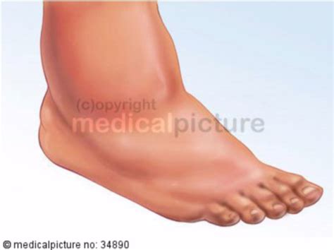 Diabetic Foot Syndrome Charcot Foot Doccheck