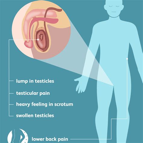 Testicular Cancer Signs Symptoms And Complications