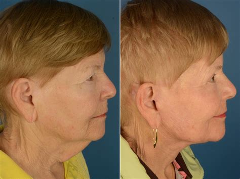 Endoscopic Facelift Photos Naples Fl Patient 22150